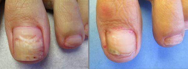 Laser Fungus Before & After 1 treatments.