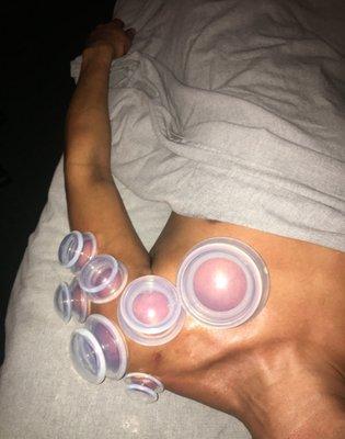 Cupping Therapy for overuse injuries.