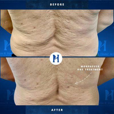 MORPHEUS8 is a radiofrequency for stunning results after just ONE treatment!