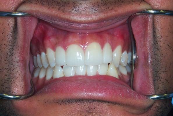 DaVinci Porcelain Veneers placed. AFTER. Happy patient!!