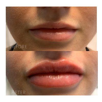 Lip Filler Results,  Beautiful and not over filled.