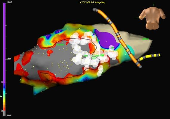 3-D rendering of left ventricle during ablation of ventricular tachycardia.