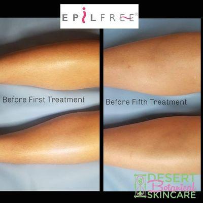 Epilfree Non-Laser Hair Removal Treatment