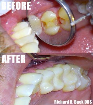 White Resin Composite Fillings By a Patient that wanted a "Dentist Near Me"