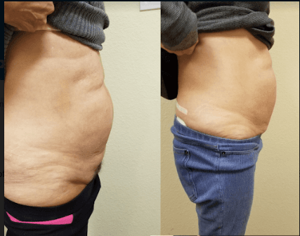 Actual results after 4 treatments of Body Sculpting.