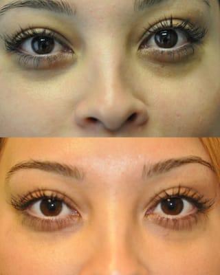 The sunken dark under eyes of this patient were beautifully corrected with Restylane and skincare treatments.