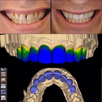 Digital Smile Design. Another Smile Lift by Dr. Tracey Nguyen.  Follow @drtraceynguyen on Instagram and Twitter.