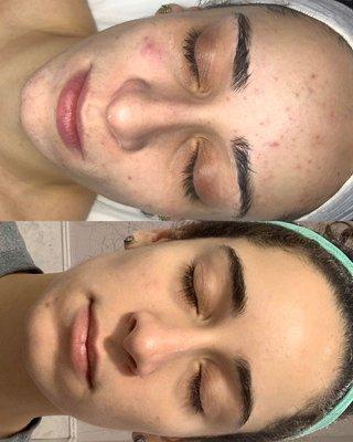 Before and After Results from Acne Bootcamp