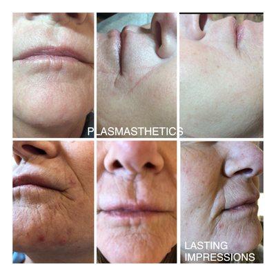 If you have a special event soon!  Tighten those wrinkles in one visit at Lasting Impressions❤️