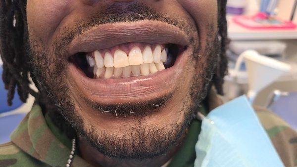 This gentleman recently visited our dental office here in Great Neck.  He originally broke his front tooth as a child, tried to repair it, a