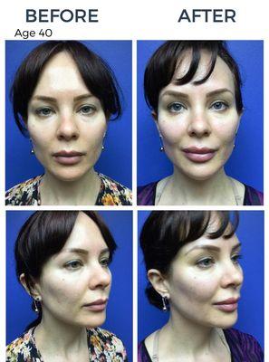 Our beautiful patient wanted to reclaim the look of her younger years. Fillers of the cheeks and chin strengthened and defined her jawline.