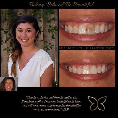 Dental Magic - Composite Filling and Porcelain Crown