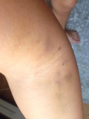 Bruising 8 days later from simple needle stick / blood test for insurance.