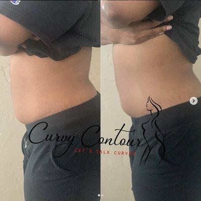 Body contouring Houston TX