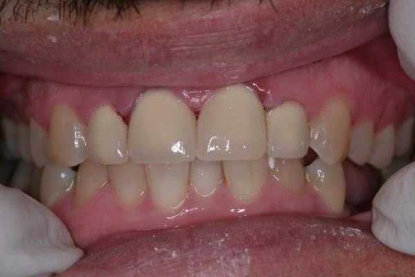 This patient had a workplace accident where he broke his upper four front teeth. This picture shows his beautiful crown work....