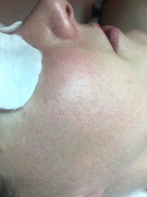 Beginning of Microneedling treatment