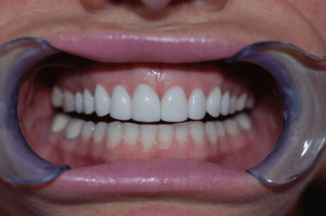 After First Choice Dental veneers