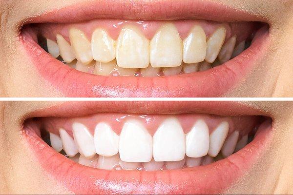 Teeth whitening, Brighten your smile two shades lighter