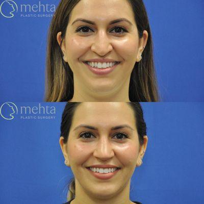 Rhinoplasty before (top) and after (bottom)