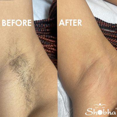 Glowing skin, no harsh chemicals! Shobha's sugaring for perfect hair removal.