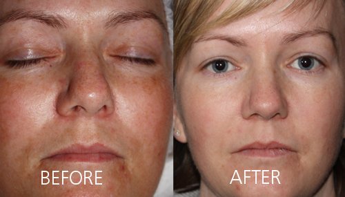 Pixel Perfect Laser Resurfacing