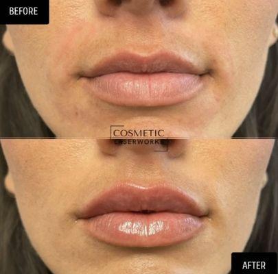 Lip Filler - Beverly Hills, CA Cosmetic Laser Works