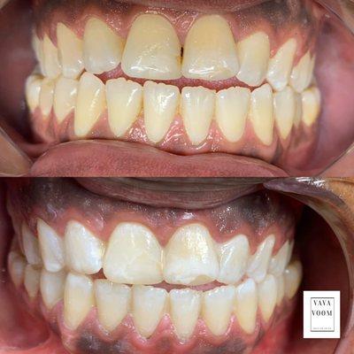 Before and After 60 min Teeth whitening session