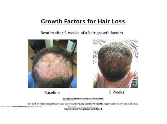 Growth Factors are topically applied for the most natural treatment to stimulate hair growth.