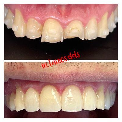 Restored chipped, fractured and eroded teeth porcelain crowns and veneers.