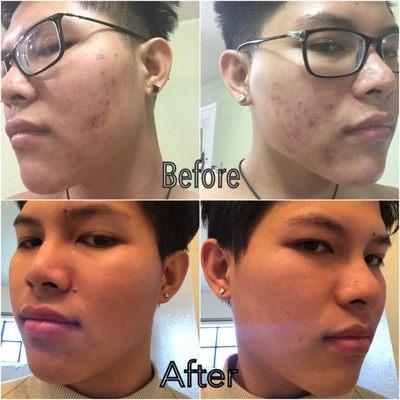 Acne treatment grade 2. This is our treatment for 6 times