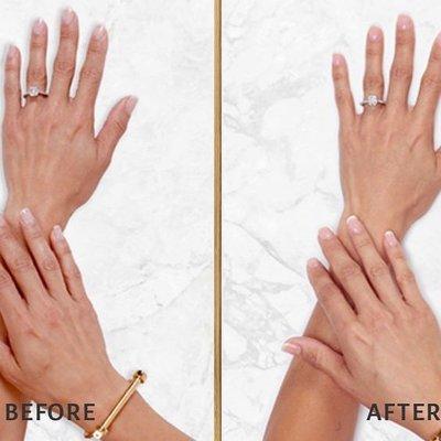 Restylane Lyft Procedure. Rejuvenation of the hands.