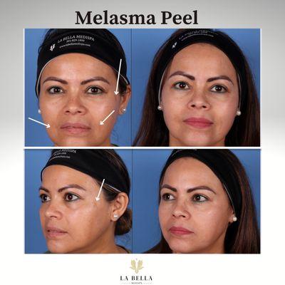 Melasma peel before and after treatment