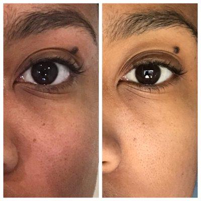 Before (left) and after (right) a single microdermabrasion treatment. Notice deep under-eye creases are much more shallow.