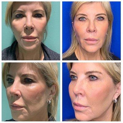 Left (before) and Right (after) treatment with fillers for the cheeks and nasal labial folds, lip filler, and neuromodulators for crows feet