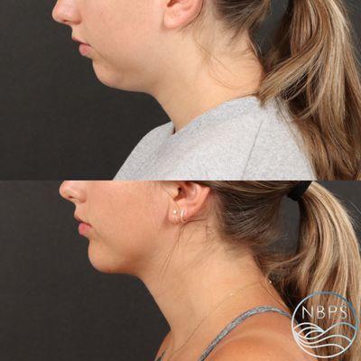 Submental Liposuction and Chin Augmentation