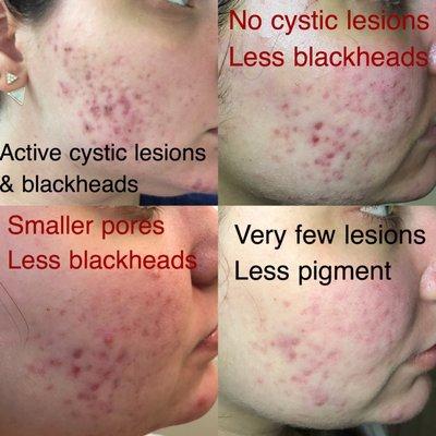 Acne Patient: Detox deep clean treatments 2 weeks apart for 2 months + recommended skincare regimen