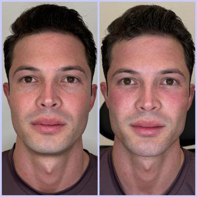 Facial Balancing with jawline and chin enhancement 

PRF undereye rejuvenation