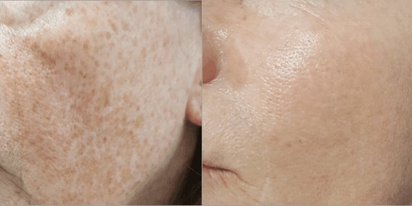 IPL Photofacial before and after.