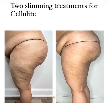 Cellulite treatment