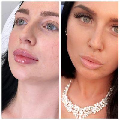 Immediately following lip injections and then settled few weeks later, ready for a night out!