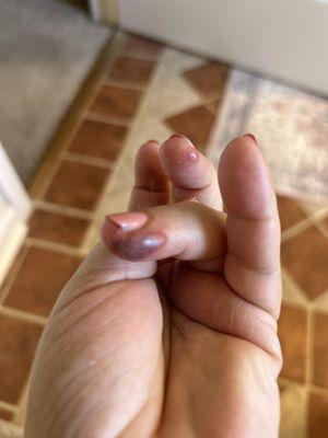 Finger nail infection