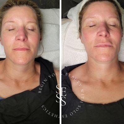 Cryo neck firming treatment