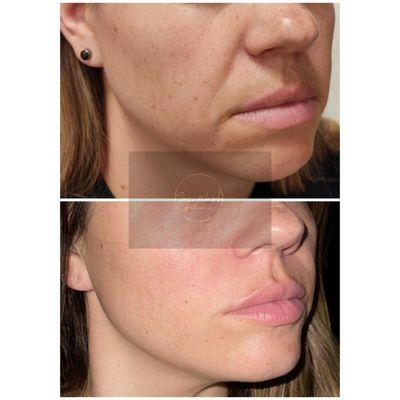 Notice the  improvement 1 month after filler treatment, and microneeding to tighten skin