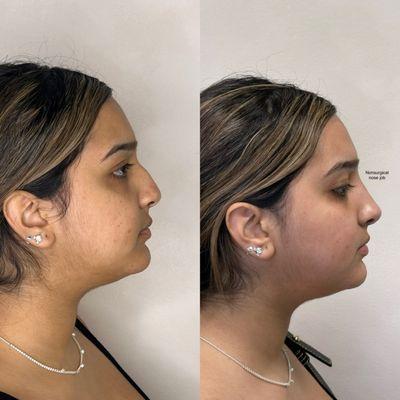 Non-surgical Rhinoplasty