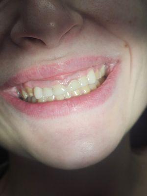 After photo of crowning my 6 front teeth (damage from years of acid reflux and vomiting)
 Good person, good dentist!