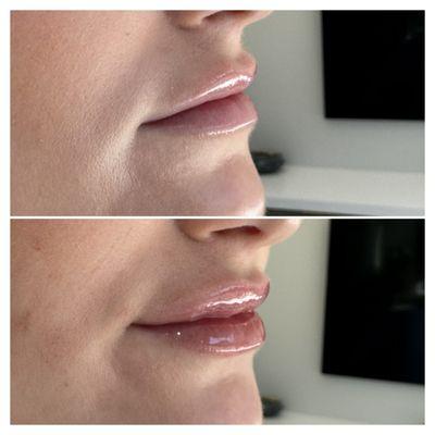 Before and After - natural and subtle lip filler