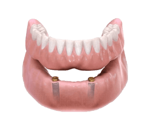 Full Mouth Dental Implants