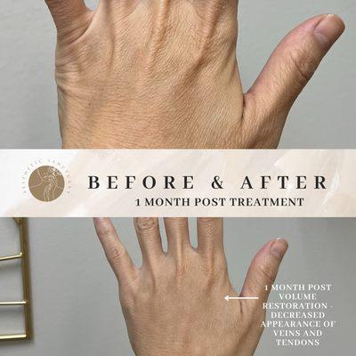 1 month post-treatment: volume restoration of bilateral hands