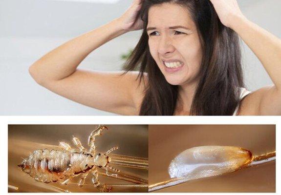 If you have Head Lice, don't panic, we can help you.