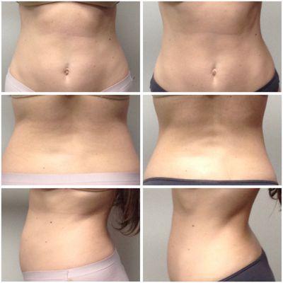 12 Body Contouring sessions